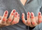 Flare Autoimun Mendadak? Mayapada Hospital Siap Menolong 24 Jam!