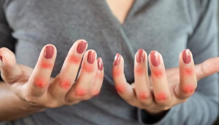 Flare Autoimun Mendadak? Mayapada Hospital Siap Menolong 24 Jam!