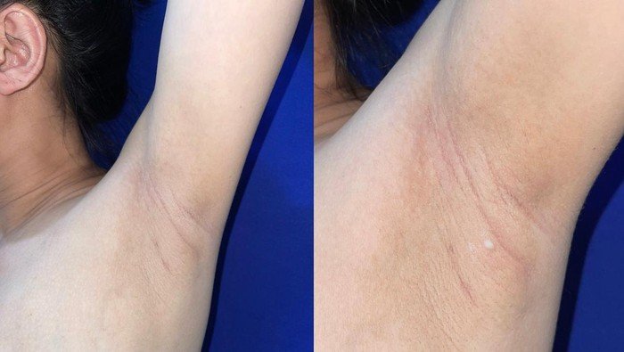 **Viral Kondisi Langka ASI Keluar dari Ketiak, Dokter: Nggak Normal Tapi Banyak Terjadi**