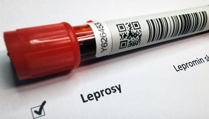 Kusta Menyerang WNI di Rumania Usai 44 Tahun, Jadi Kasus Pertama Sejak Dulu