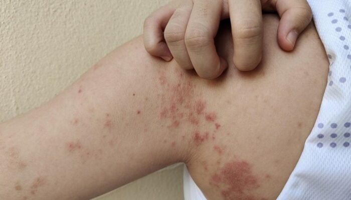 Kemenkes Ingatkan: Ciri-ciri Kusta yang Disepelekan, Waspadalah dari Dini!