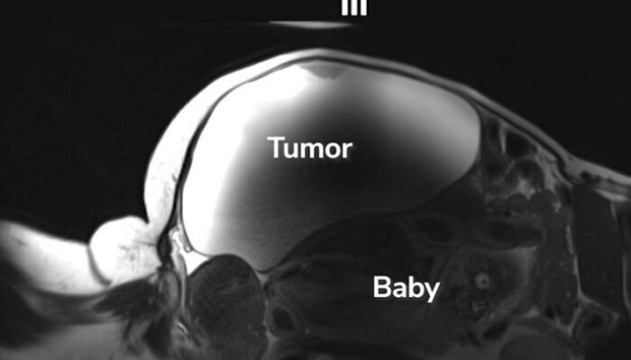 Langka! Ibu Ini Lahirkan Bayi dari Kehamilan di Luar Rahim dengan Kista Hampir 10 Kg – Update 2