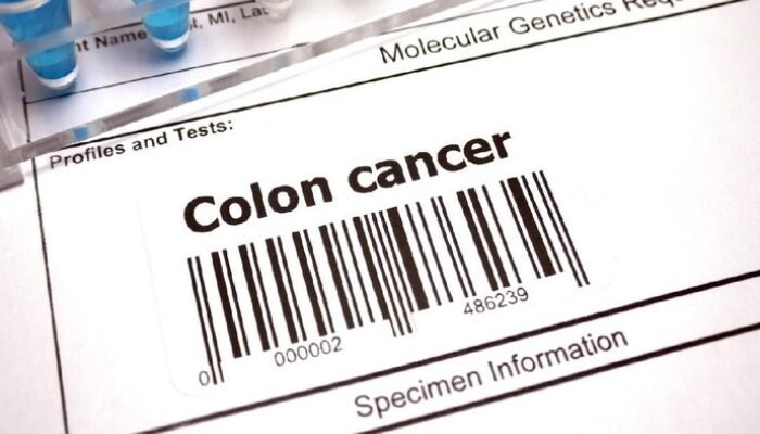 Kisah Wanita 24 Tahun Kena Kanker Usus Stadium 4, Ini Gejalanya – Update 2