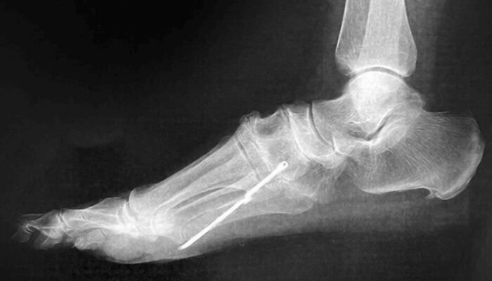 [Sangat Mengejutkan! Dokter Temukan Besi Nancap di Kaki Pasien Setelah 40 Tahun]