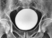 **Dokter Temukan Batu Kemih Raksasa, Ukurannya Seperti Telur Burung Unta!**