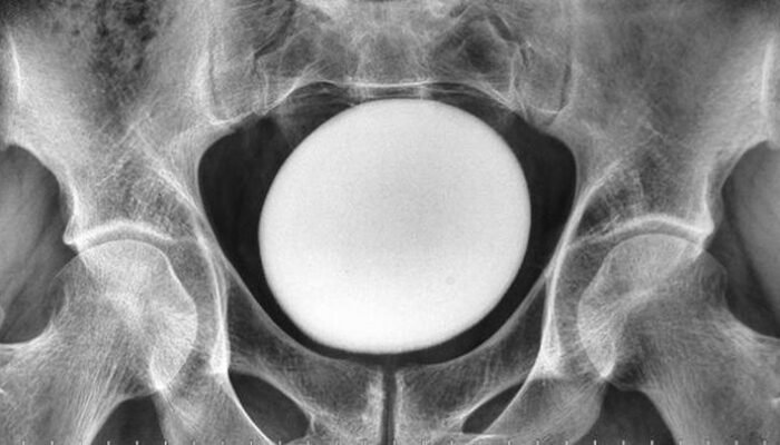 **Dokter Temukan Batu Kemih Raksasa, Ukurannya Seperti Telur Burung Unta!**