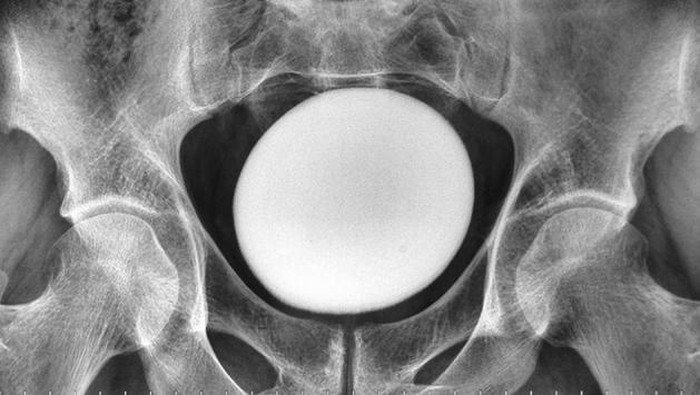 **Dokter Temukan Batu Kemih Raksasa, Ukurannya Seperti Telur Burung Unta!**
