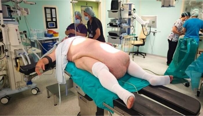 “Perut Pria Ini Membesar Tak Wajar, Ternyata Ada Tumor Sebesar 32 Kg: Fakta dan Pengaruhnya pada Kesehatan”