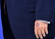 Dosis Tinggi Aspirin: Apakah Ini Sebab Tangan Lebam Trump Usai Davos?