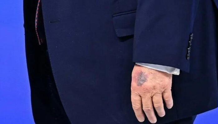 Dosis Tinggi Aspirin: Apakah Ini Sebab Tangan Lebam Trump Usai Davos?