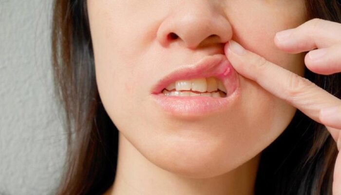 Sariawan Ternyata Bisa Jadi Petunjuk Awal Kanker, Jangan Sampai Menunda!