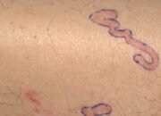 Pria Heran Ruam Kulitnya ‘Bergerak’, Rupanya Ada Cacing yang Merayap – Update 1