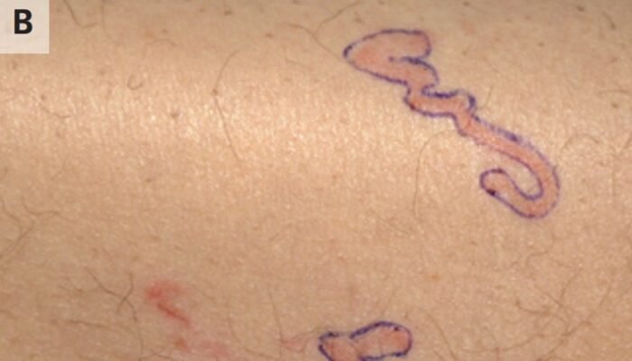 Pria Heran Ruam Kulitnya ‘Bergerak’, Rupanya Ada Cacing yang Merayap – Update 1