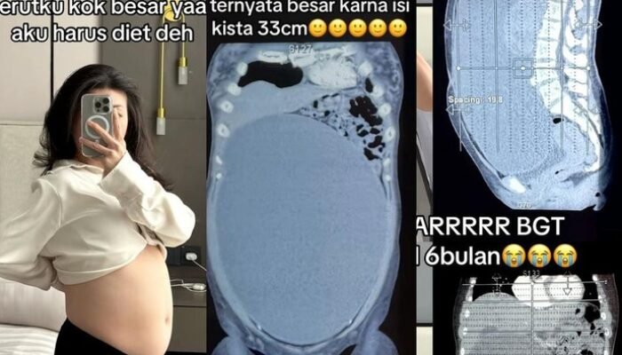 2. “Kisah Wanita Surabaya dengan Kista 33 cm: Bagaimana Ini Terjadi?”