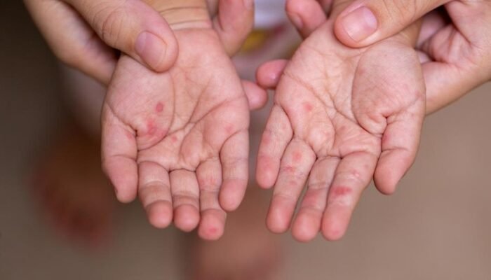 **Mengapa Campak Meningkat di Indonesia? Menkes Budi Gunadi Sadikin Jawabnya**