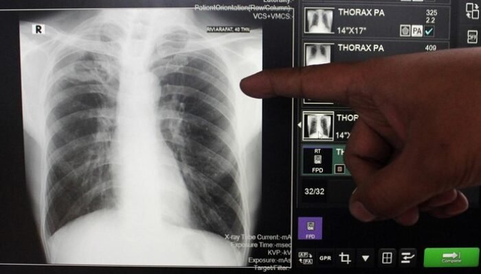 2. “Herbal Sebagai Obat TBC? Fakta-Fakta Klaim Sesat Influencer yang Wajib Diketahui”